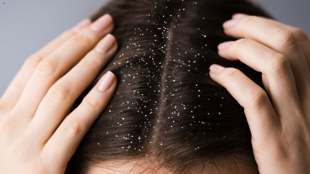 7 oils for dandruff. Understanding Dandruff: Causes and Triggers